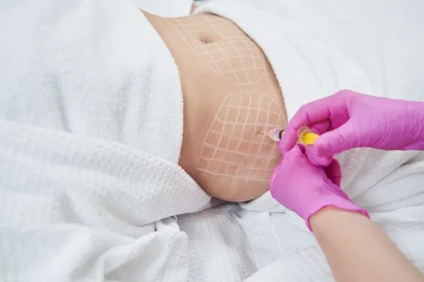 image of fat dissolving injections on love handles to help combat weight gain Willenhall