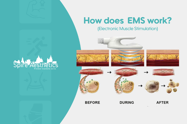 EMS treatment for post pregnancy weight loss treatment Willenhall