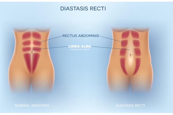 What Non-Surgical Options Are Available for Diastasis Recti Willenhall?