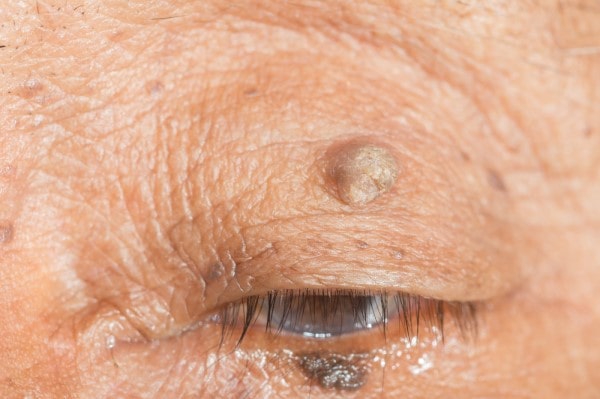 Skin imperfections Willenhall - Cryopen is fast and effective book in today!