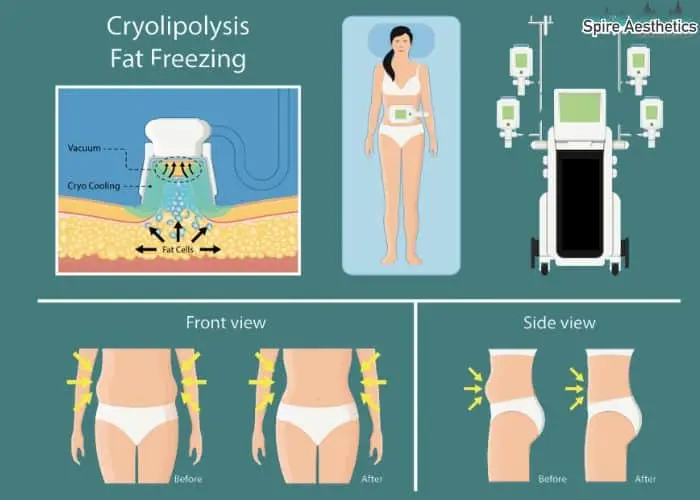 Fat freezing treatment Willenhall benefits for competitions to remove stubborn fat deposits.