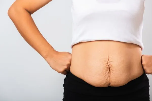 Image of a woman's stomach after weight loss with sagging skin following a gastric band Willenhall