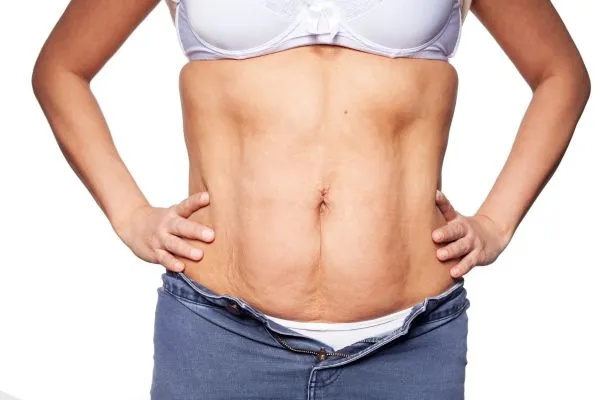 sagging skin on woman's stomach after weight loss injections Willenhall