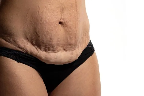 Image of womans stomach after weight loss injections Willenhall showing saggy skin
