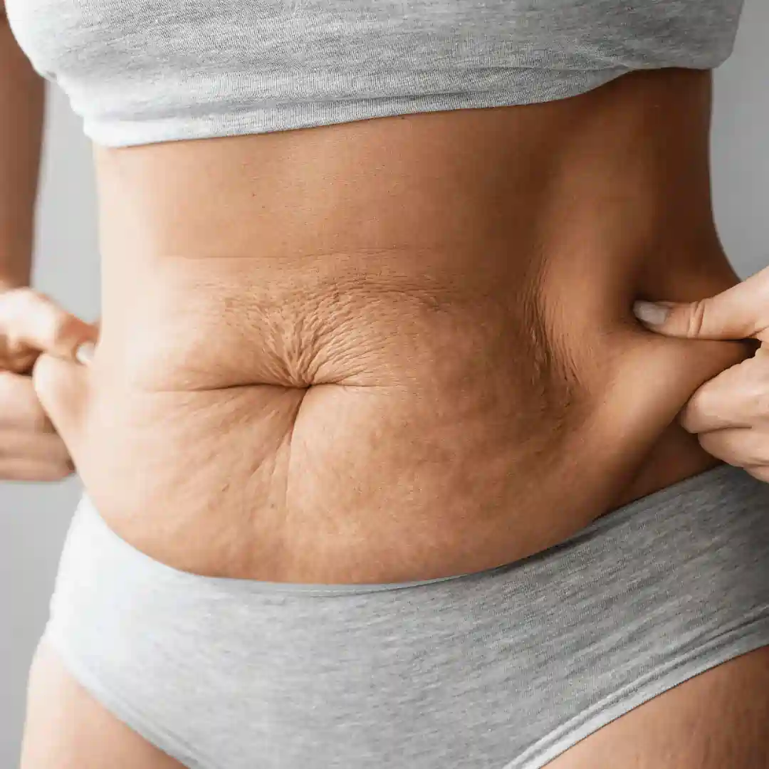 Is It Normal to Have Loose Skin After Pregnancy Willenhall?