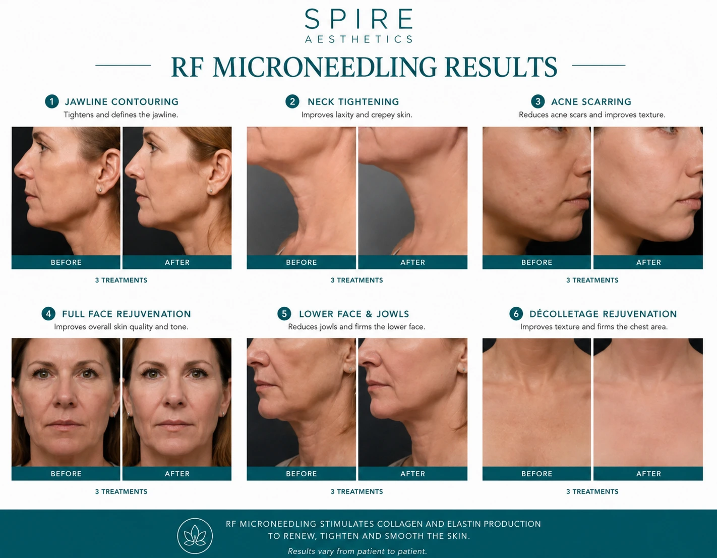 RF Microneedling Skin tightening Willenhall results