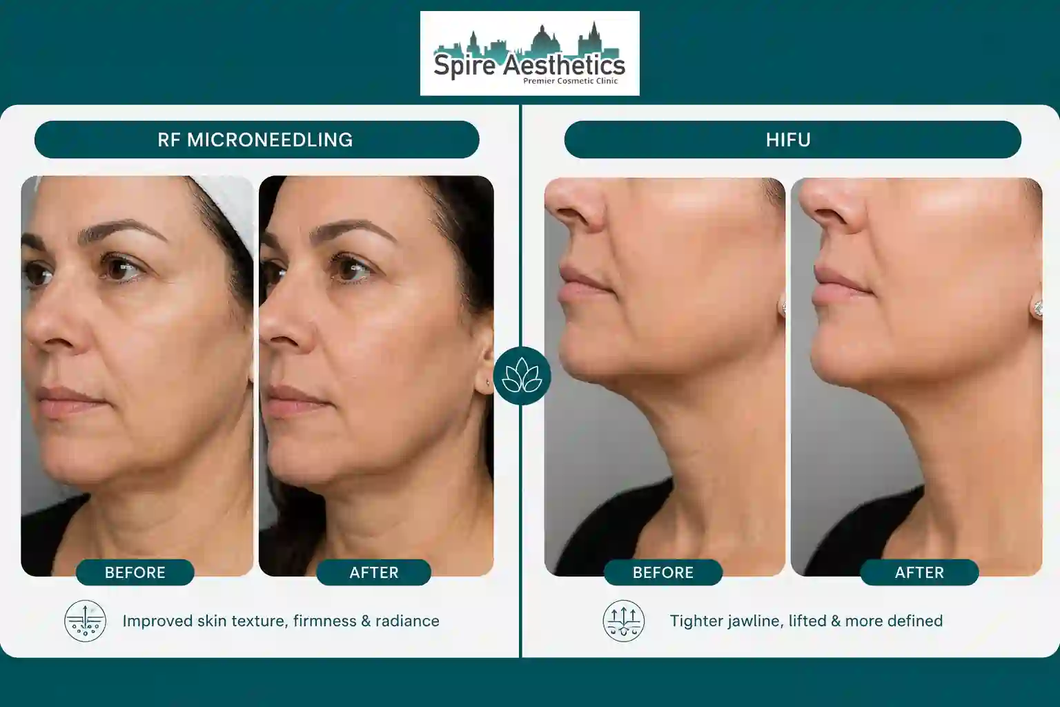 Can RF Microneedling and HIFU Be Combined Willenhall?