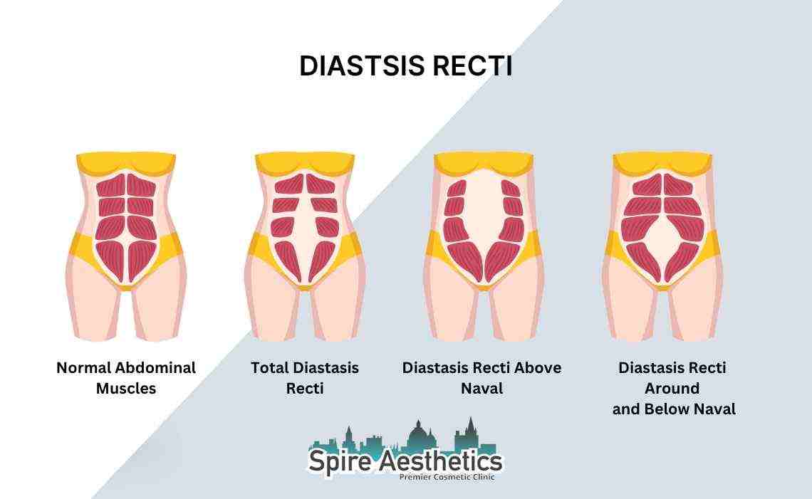 Is Non-Surgical Diastasis Recti Treatment Right for You? Common Concerns Answered Willenhall
